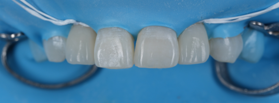 If Your Front Teeth Look Extra Large, Be Sure to Read This — Gyodae Station Dental Clinic image 8