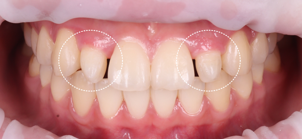 Seocho Dental Clinic Case of Gummy Contouring and Resin Treatment for a Peg Lateral Tooth in an Out-of-Town Dental Hygienist image 3