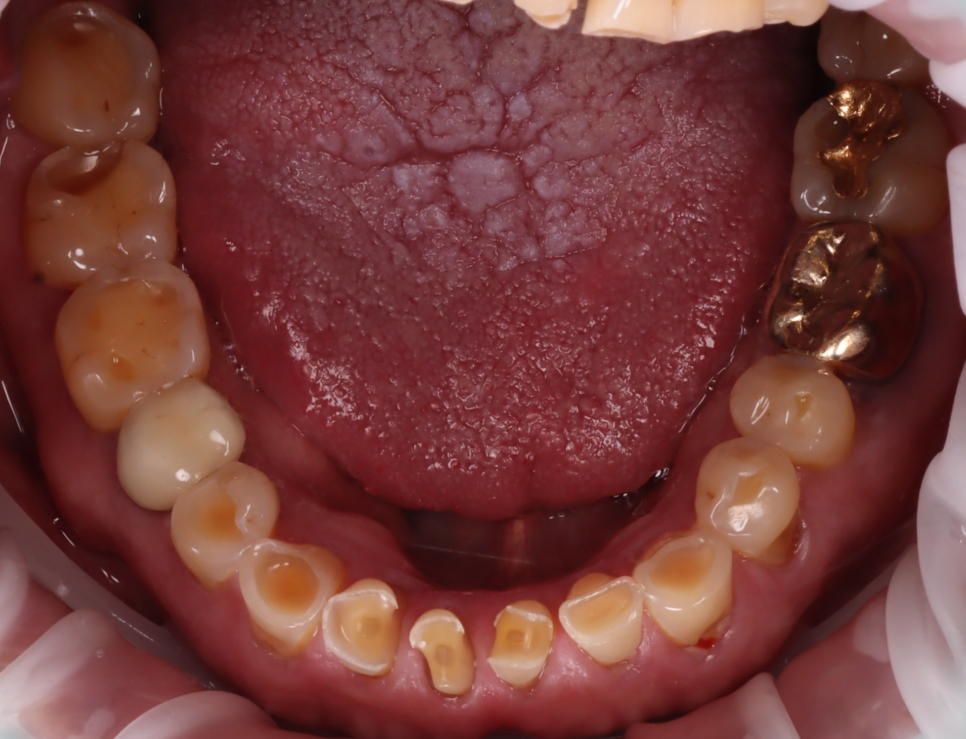 신논현역치과 심하게 마모된 60대 남성 앞니 크라운 치료 관련 이미지 5