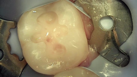 서초동치과 치아 삭제 원하지 않는다면 오버레이 하세요 관련 이미지 4