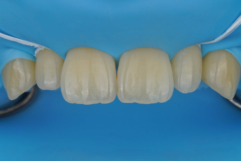 왜소치 레진, 갤럭시네이트 레진비니어로 당일 치료완료 (서초동 치과) 관련 이미지 6