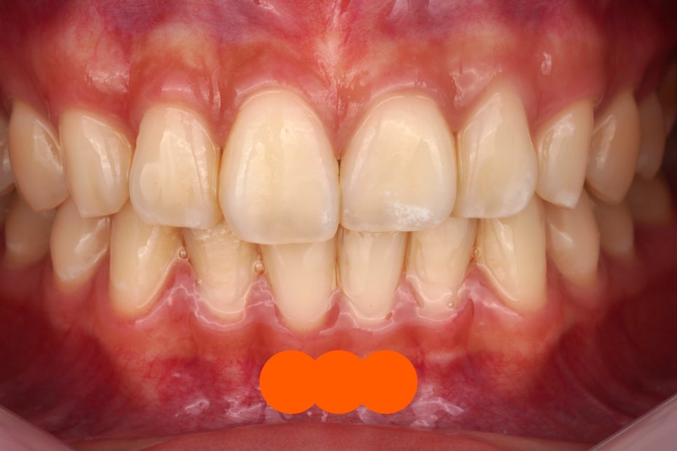 강남역 근처 치과, 투스젬 제거는 여기로 와야합니다 관련 이미지 7