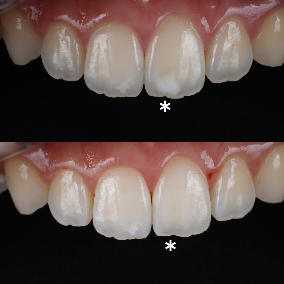 강남치과추천 앞니 하얀 반점 당일 심미 레진으로 해결 관련 이미지 8
