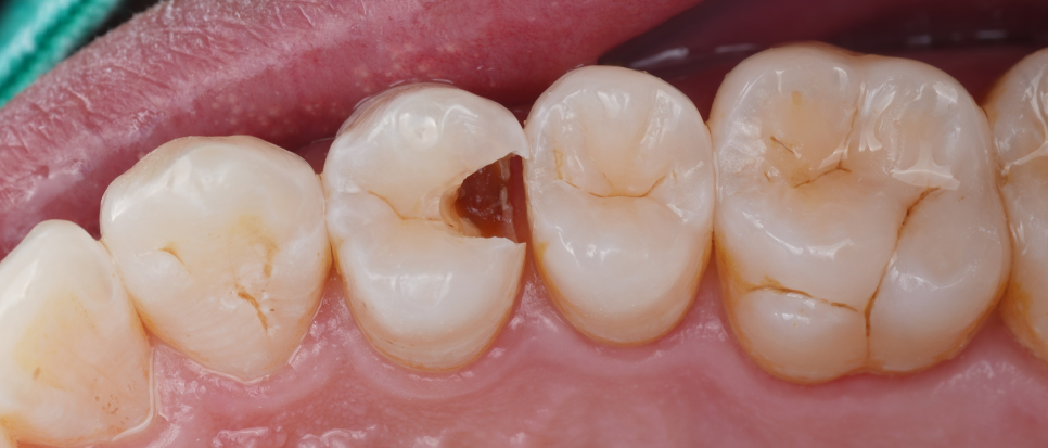 강남역치과 치료 부위 2차 충치 레진 재치료 사례 관련 이미지 6