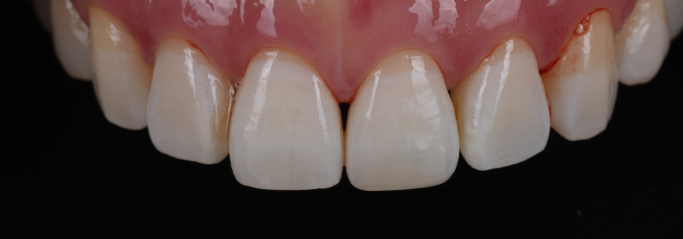 강남치과 짧아 보이는 치아 레진으로 당일 치료 관련 이미지 11