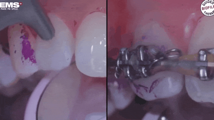 앞니 벌어짐 레진 비니어 후 미인대회 출전 관련 이미지 7