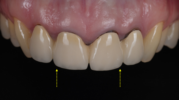 신논현치과 외국인 까만 앞니 크라운 교체 사례 관련 이미지 9