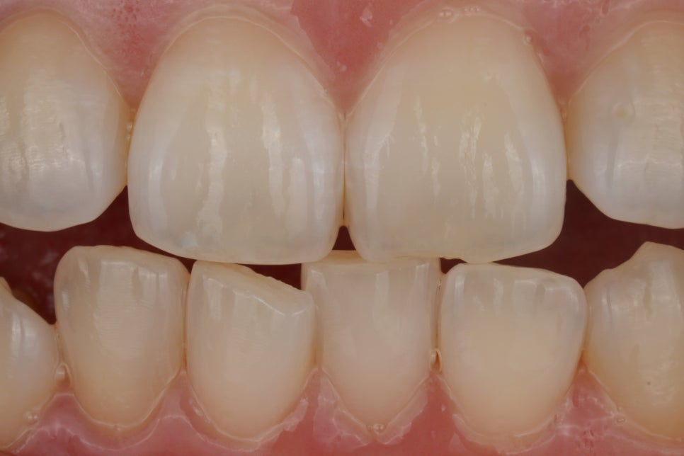 앞니 살짝 깨짐, 치아 성형으로 해결한 교대역 치과 관련 이미지 2