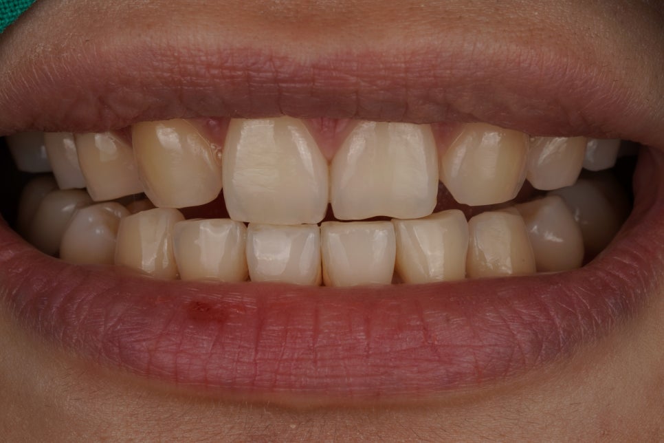 앞니살짝깨짐 치아성형은 역시 교대역 재주좋은 치과 관련 이미지 1