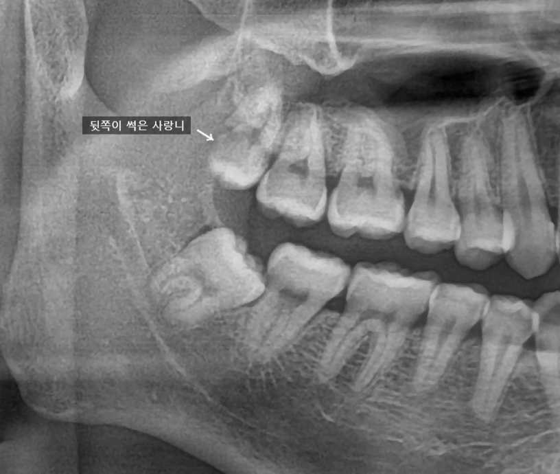 교대역 사랑니 통증 자주 생긴다면? 발치 타이밍 가이드 관련 이미지 1