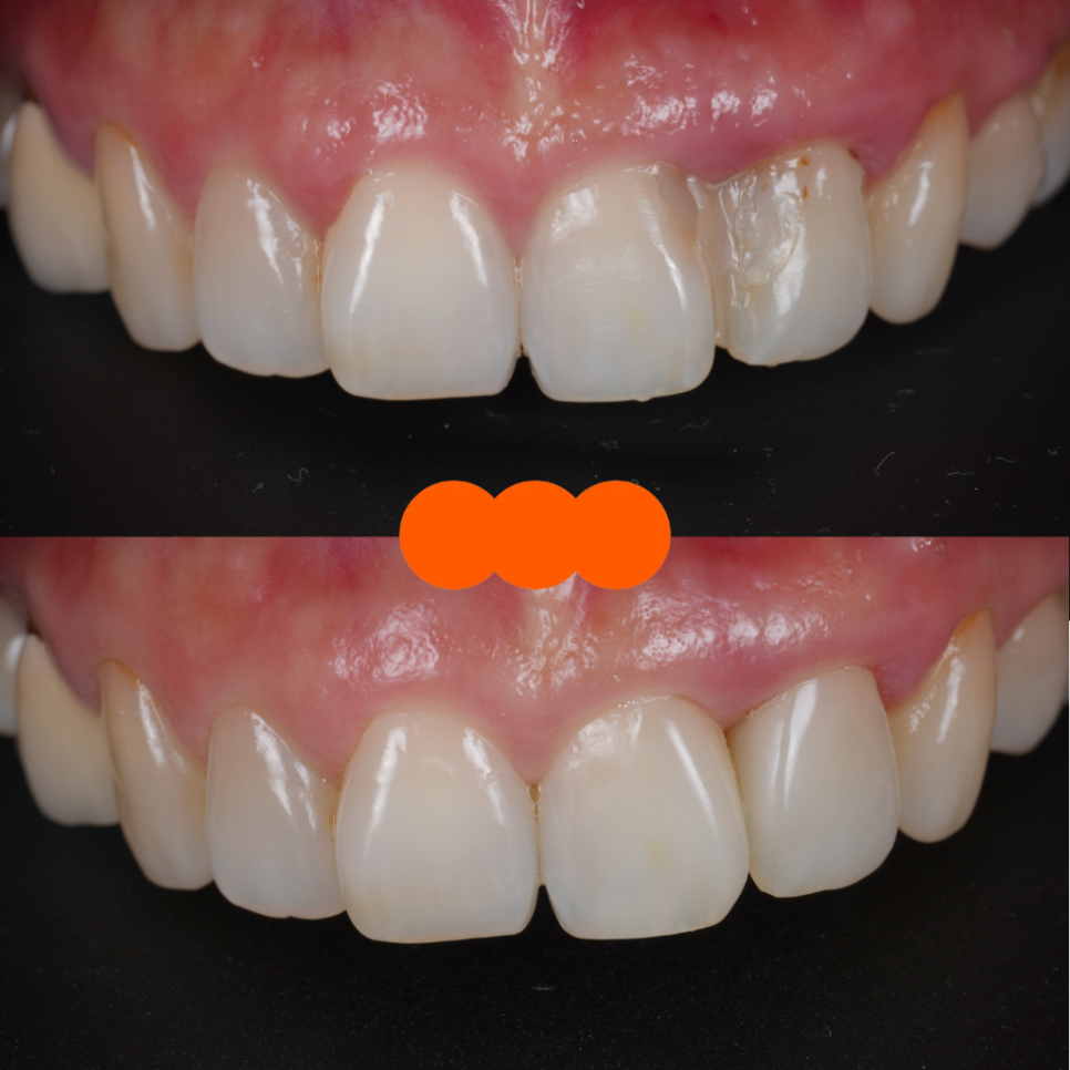 잘못된 앞니 레진 뼈까지 녹인다? 레진 재치료 과정 관련 이미지 17