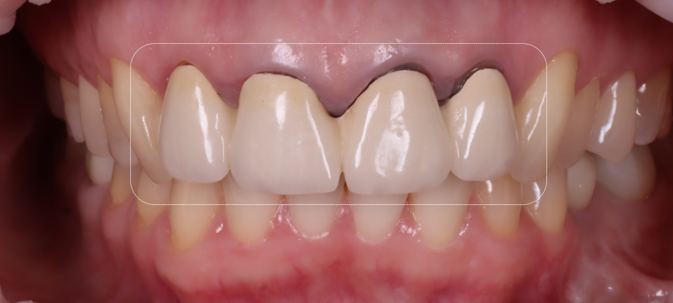 앞니 크라운 재치료 시니어에게 더 중요한 이유 관련 이미지 4