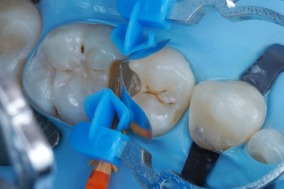 어금니 신경치료 안하고 레진빌드업, 교대역 치과 재주좋은치과 관련 이미지 3