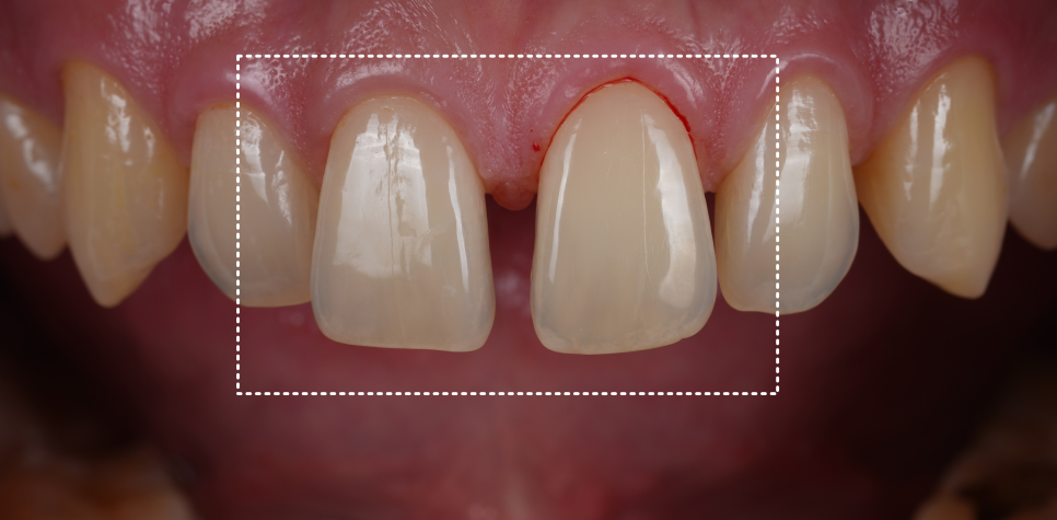 서울치과 앞니 레진 전 이걸 먼저 확인해야 돼요 관련 이미지 2
