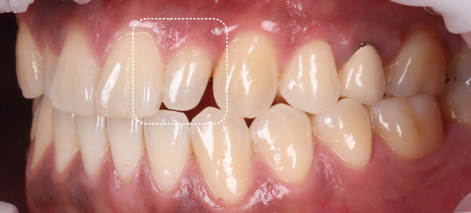 강남역치과 왜소치 레진 비니어로 삭제없이 가지런히 관련 이미지 4
