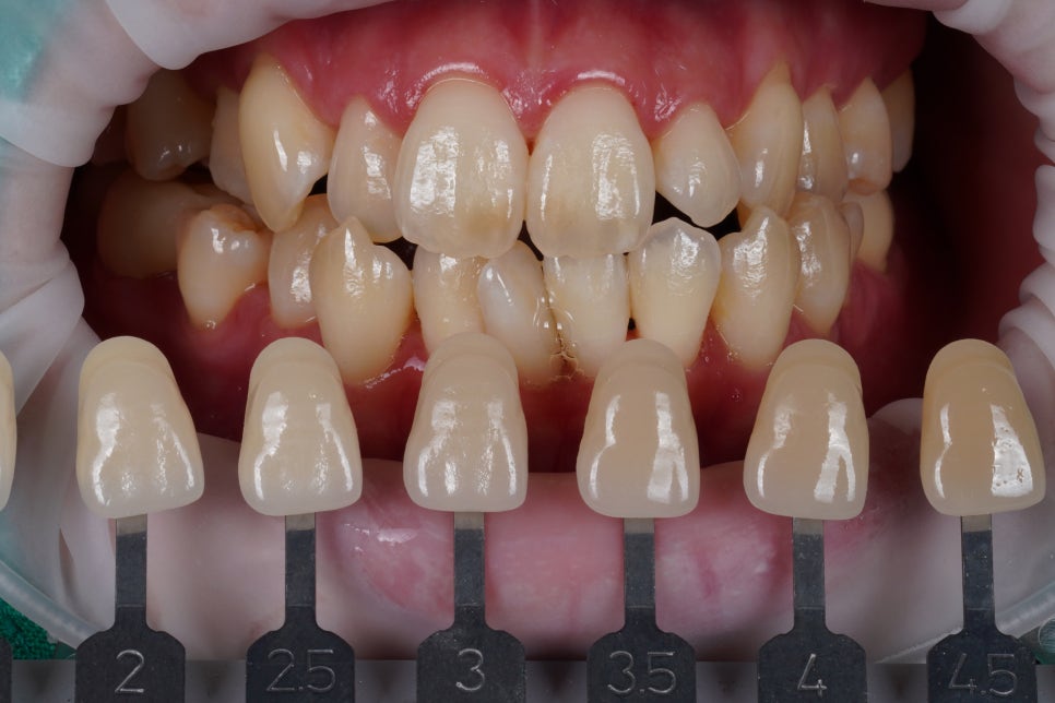 반포동 원데이 치아 미백, 라미네이트 필요 없을지도? 관련 이미지 1