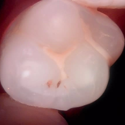교대역 레진 실란트 밑에 깊은 2차충치 레진빌드업으로 당일 재치료 관련 이미지 2