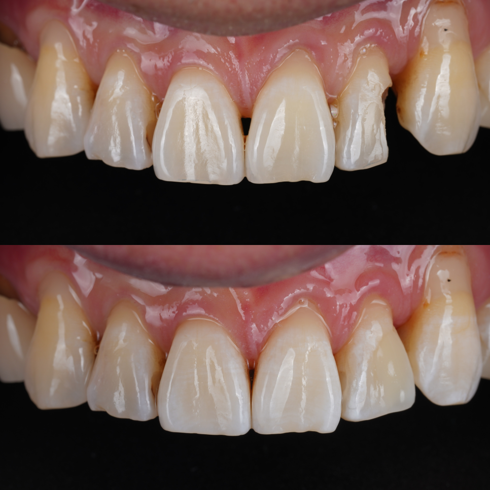 서초구치과 레진 탈락 재치료 2가지가 성공 핵심입니다 관련 이미지 1