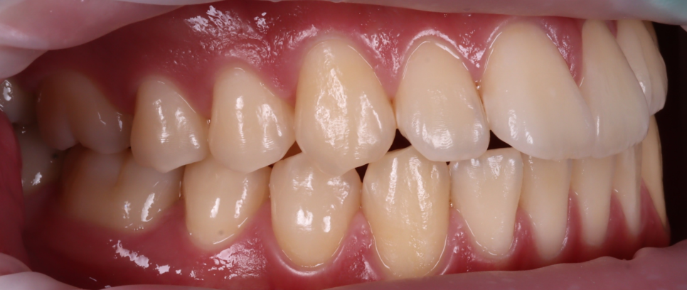 역삼역 치과 치대생 깊은 충치 신경치료없이 레진으로 완료 관련 이미지 4