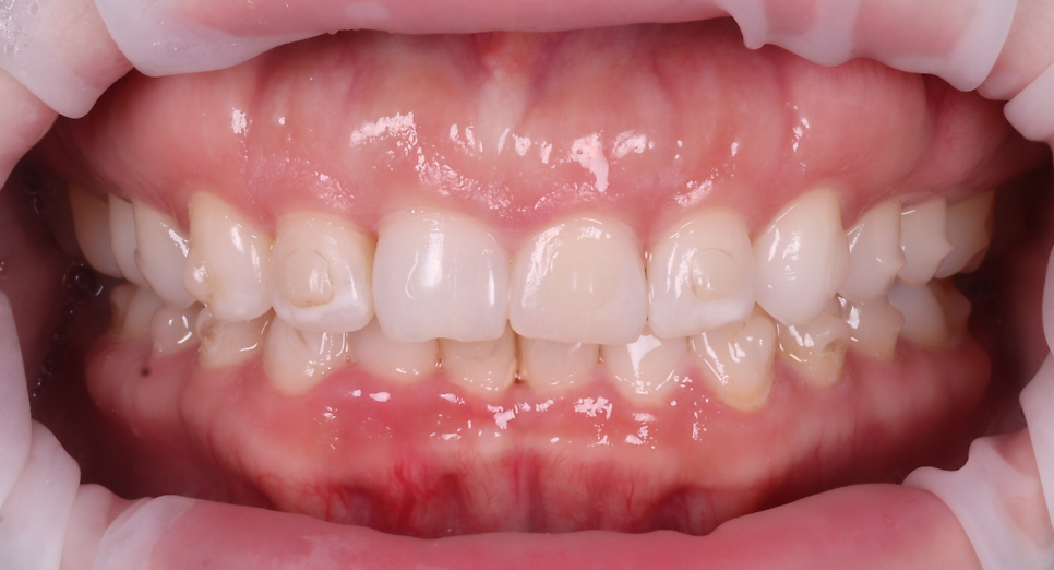 신사역치과 미국에서 교정 중이던 분 앞니 레진으로 고민 해결 관련 이미지 5