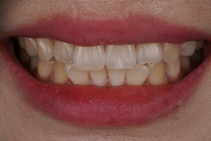 서초동 반점치 레진, 웨딩 촬영 전 앞니 치과치료 관련 이미지 2