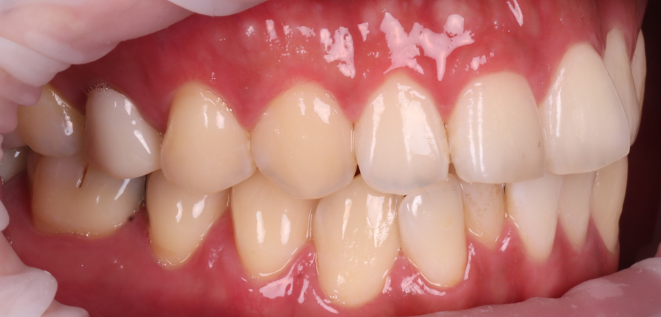 Do Cavities Between Teeth at Sinsa Station Dental Clinic Have to Be Treated with an Inlay? Resin Is Also an Option image 2