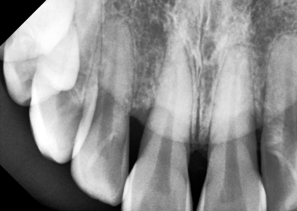 블랙 트라이앵글 (블트) 레진으로 건강하게 치료하는 방법 관련 이미지 3