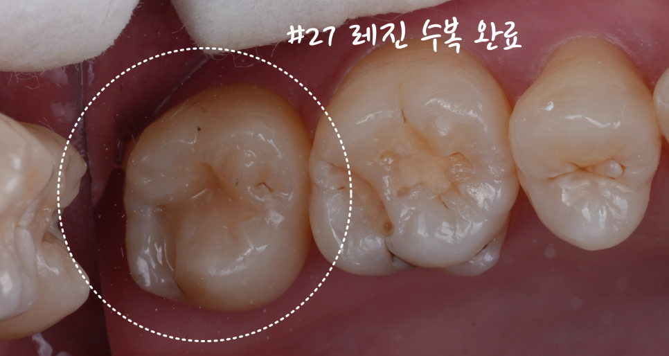 교대역치과 타치과 신경치료, 크라운 진단받았으나 레진으로 치료 관련 이미지 8