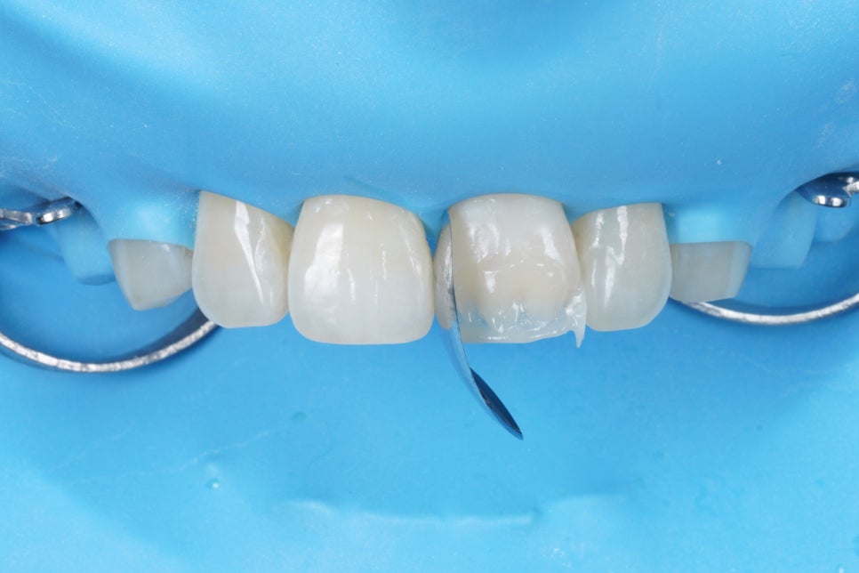 서울 앞니 레진으로 40분 안에 자연스럽게 복원한 케이스 관련 이미지 7