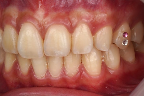 강남역 근처 치과, 투스젬 제거는 여기로 와야합니다 관련 이미지 4