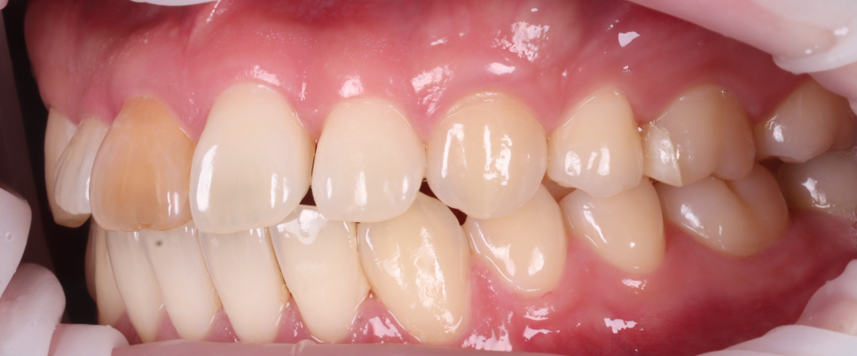 서초치과 5년간 14개 치과 돌다 본원에서 정착한 이유는? 관련 이미지 5