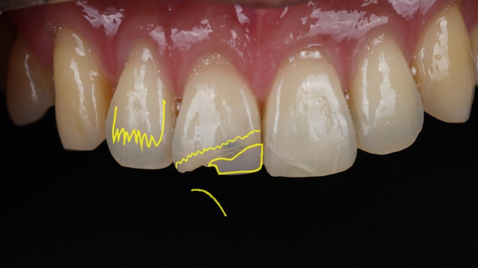 강남역치과 앞니 파절 크라운 말고 레진으로 하세요 관련 이미지 5