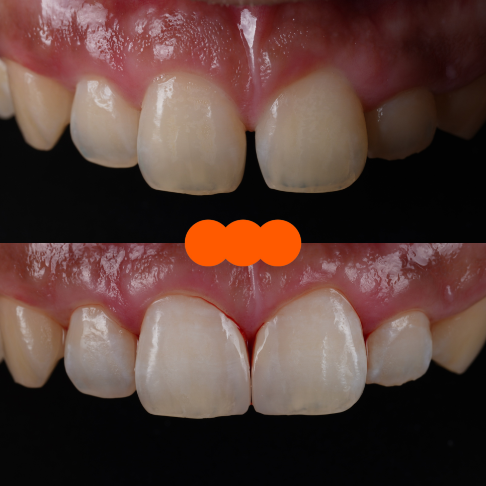 양재역치과 앞니 레진 받으러 수원에서 오신 이유(feat. 치과의사 소개) 관련 이미지 11