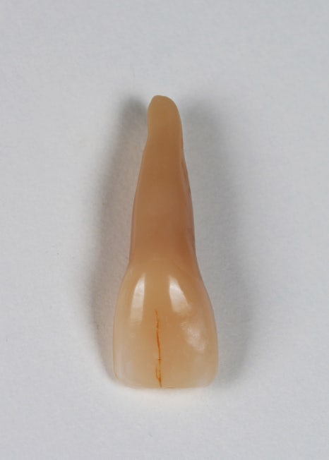 앞니 깨짐 레진 어디서할지 고민될 때 꼭 보세요 관련 이미지 2