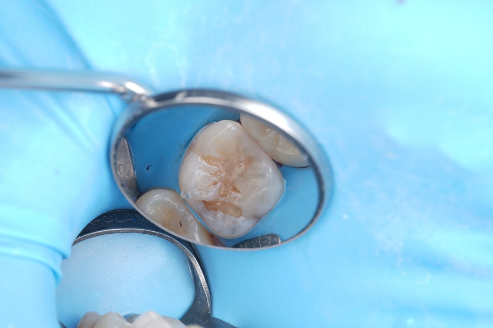 Do Cavities Between Teeth at Sinsa Station Dental Clinic Have to Be Treated with an Inlay? Resin Is Also an Option image 12