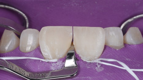 블랙트라이앵글 자연스럽게 메우는 비결은 이것 관련 이미지 11