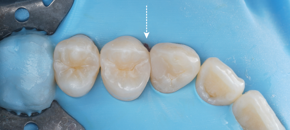역삼역 치과 치대생 깊은 충치 신경치료없이 레진으로 완료 관련 이미지 15