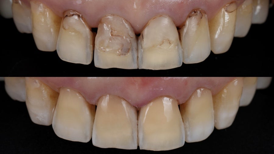 레진 변색 재치료, 다시 깨끗하게 만들어 볼까요? 관련 이미지 3