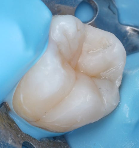 인레이치료 하방 2차 충치 레진 빌드업 사례 관련 이미지 16