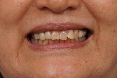 당신이 서울 교대역 재주좋은치과 라미네이트로 치료해야 하는 이유 관련 이미지 1