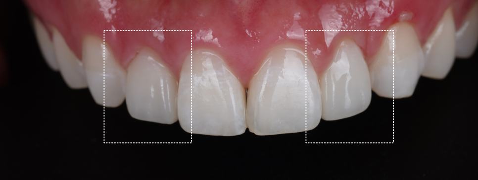 If Your Front Teeth Look Extra Large, Be Sure to Read This — Gyodae Station Dental Clinic image 10