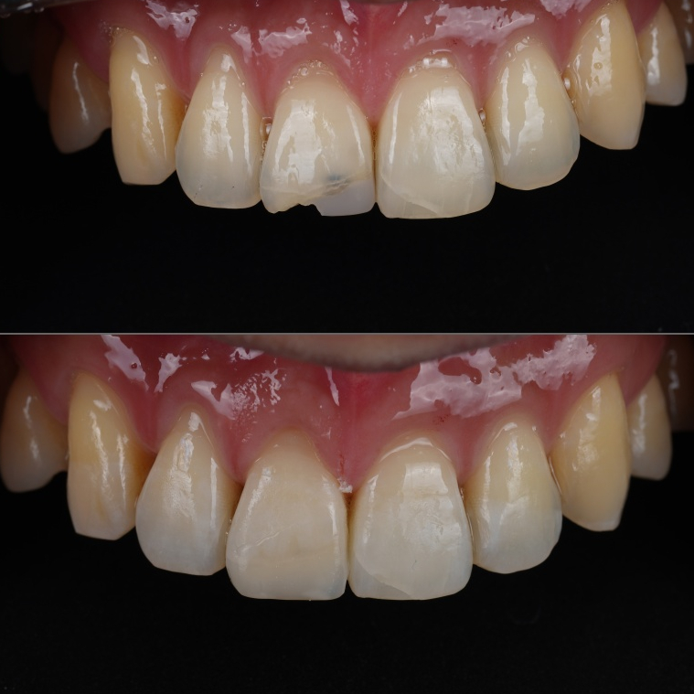 강남역치과 앞니 파절 크라운 말고 레진으로 하세요 관련 이미지 10