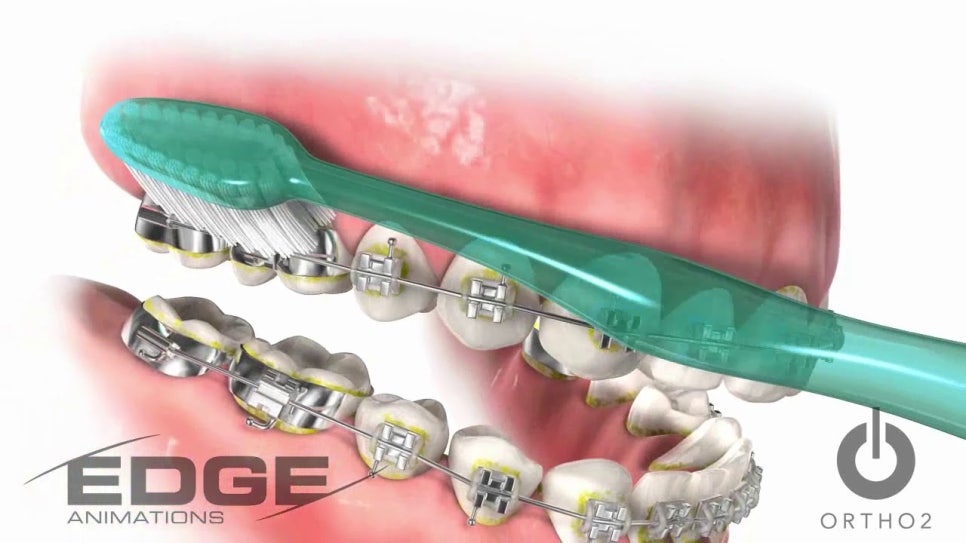 치아 교정 양치질, 아이에게 이 글을 공유해주세요. 관련 이미지 2