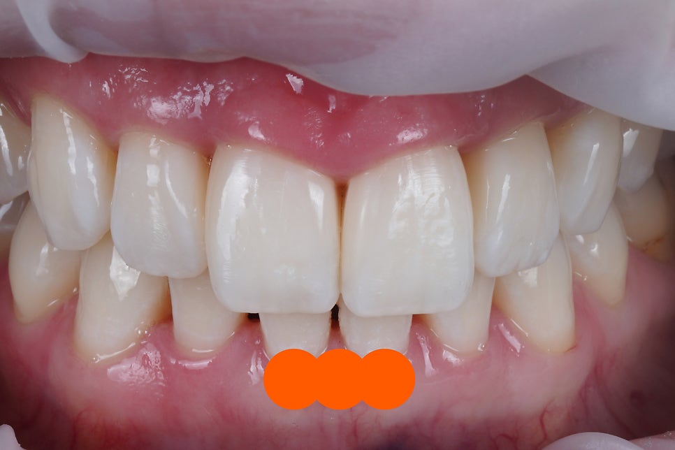 블랙 트라이앵글 (블트) 레진으로 건강하게 치료하는 방법 관련 이미지 6