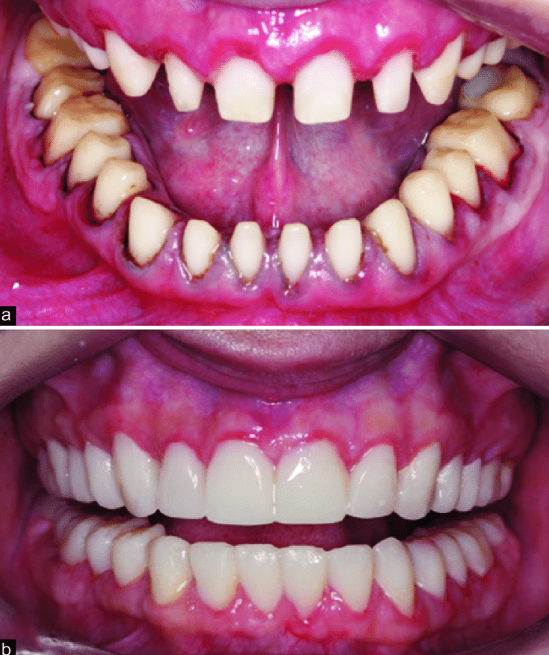 이갈이 장치 보톡스랑 함께 하면 훨씬 좋은 이유 관련 이미지 11