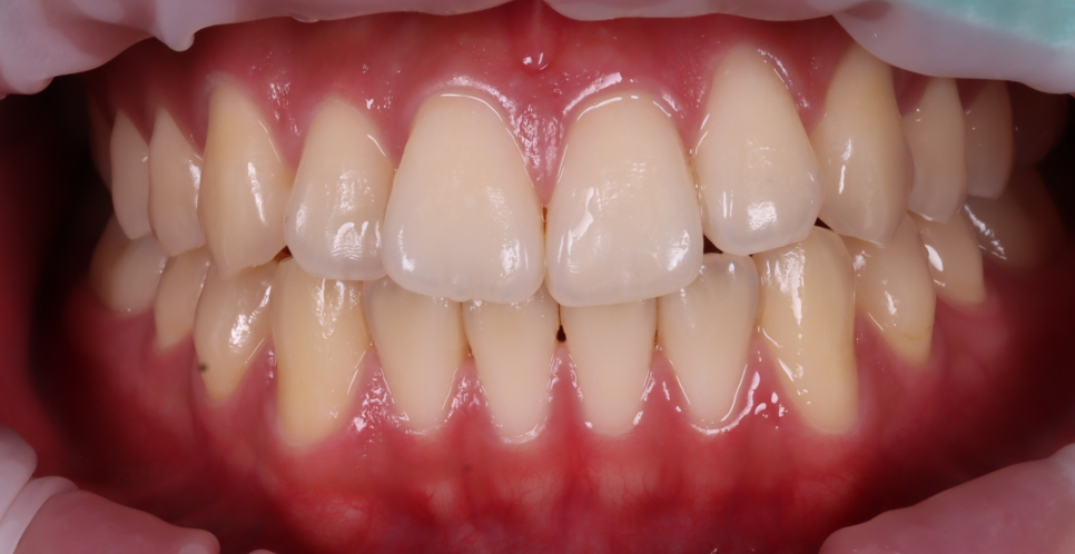 역삼역 치과 치대생 깊은 충치 신경치료없이 레진으로 완료 관련 이미지 3