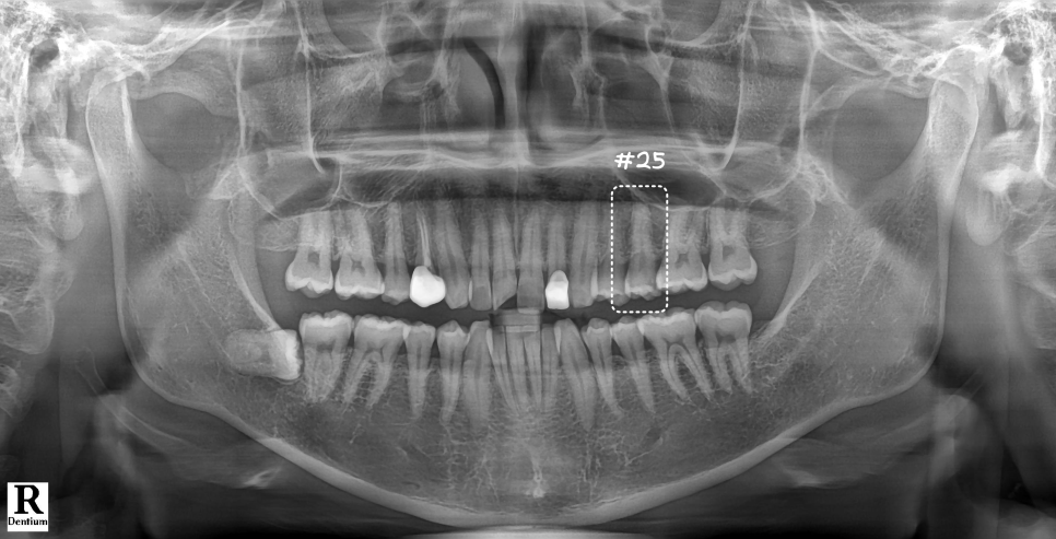 서초역치과 이걸로 신경치료 미뤄드리고 있어요 관련 이미지 4