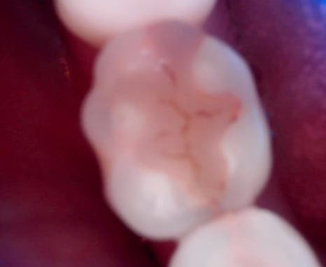 교대역 치과 보철 아래 2차 충치를 다시 레진으로 관련 이미지 22