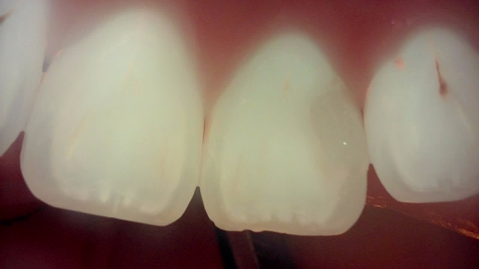 교대역치과 타치과 신경치료, 크라운 진단받았으나 레진으로 치료 관련 이미지 12