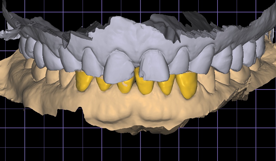 신논현역치과 심하게 마모된 60대 남성 앞니 크라운 치료 관련 이미지 9